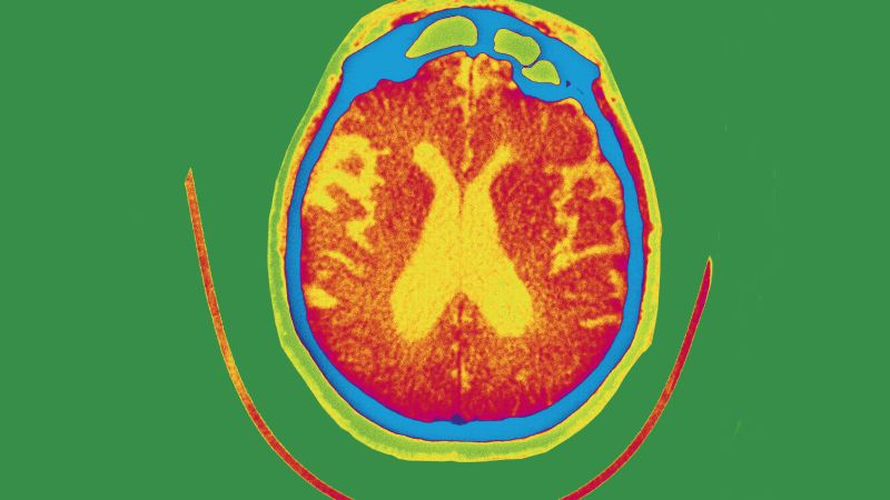 Experimental therapy gantenerumab fails to slow or improve Alzheimer’s memory loss in clinical trials