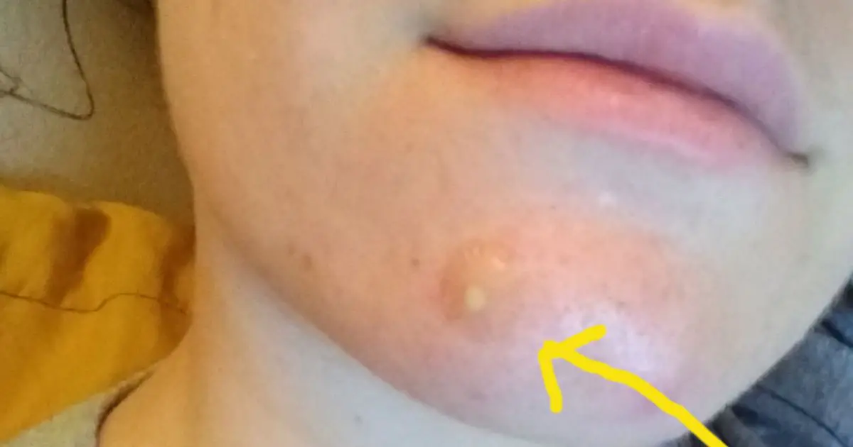 Here’s What The White Bits On Used Pimple Patches Really Are